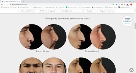 Rinoplastia (scroll down), Sitio web HTML5 Dr. Álvaro Correa